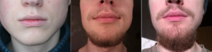 Minoxidil para el mentón
