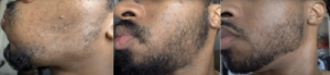 Minoxidil para el mentón