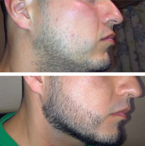 Minoxidil para el mentón