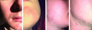 Minoxidil para el mentón